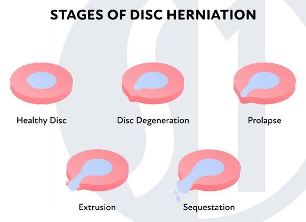 Disc Herniation Stages
