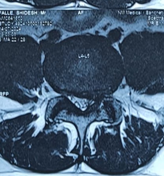 Disc Prolapse Image 1