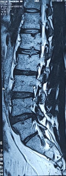 Disc Prolapse Image 2