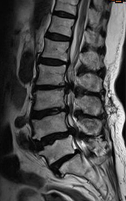 Lumbar Canal Stenosis