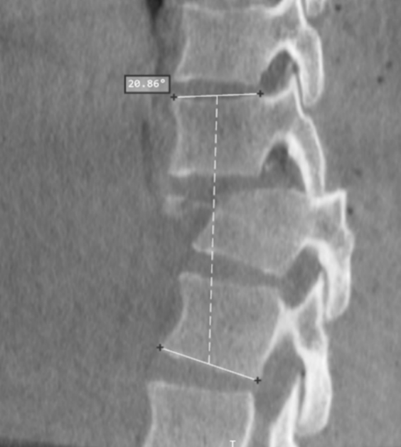 Revision Spine Surgeries