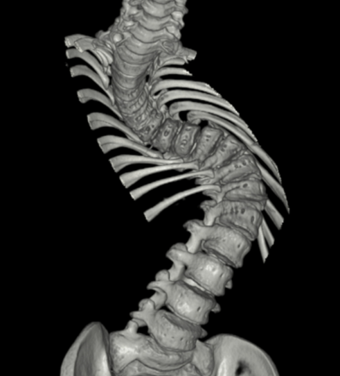 Spinal Trauma