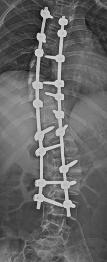 Scoliosis Correction