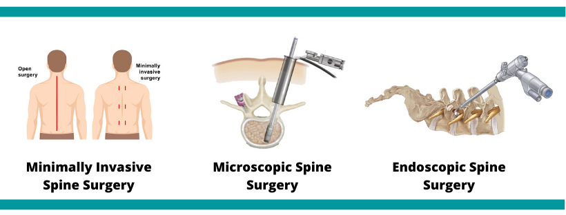 Minimally Invasive Spine Surgery in Hisar: Advanced Treatment at Orthomed
