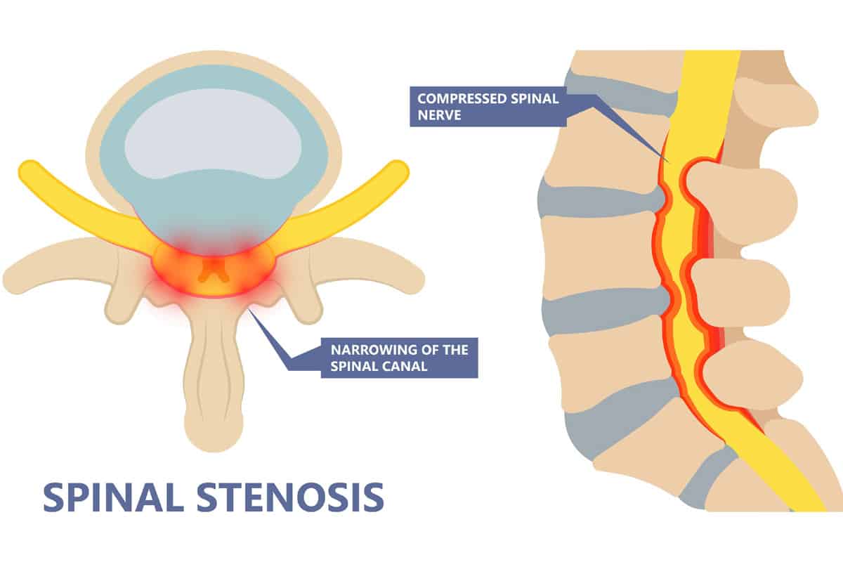 Laminectomy Surgery in Hisar: Treatment for Spinal Stenosis