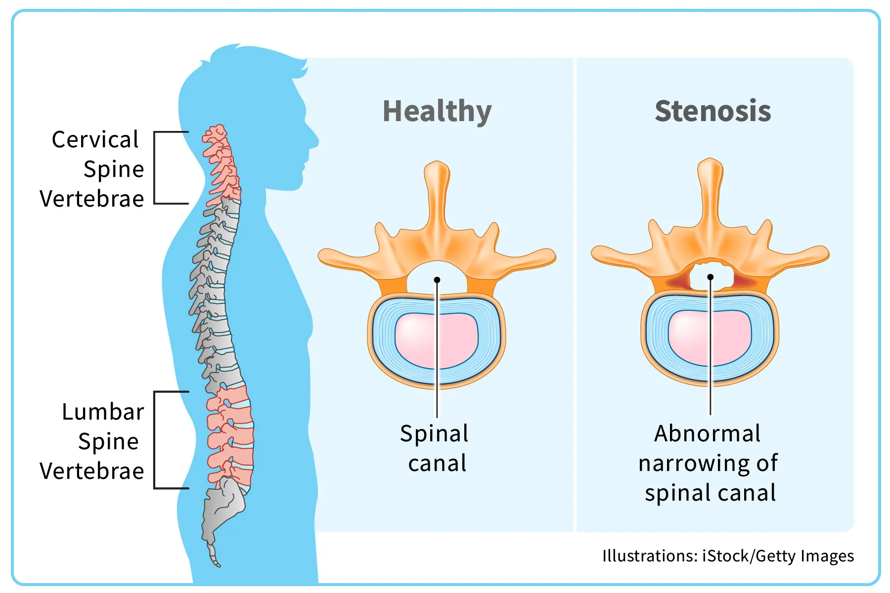 Top Spinal Stenosis Specialists in Hisar – Advanced Care for Lasting Relief