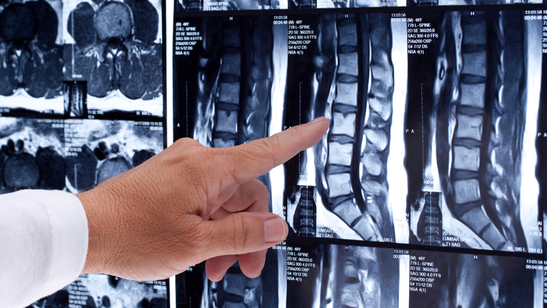 Spine MRI and Diagnosis in Hisar: Advanced Imaging at Orthomed
