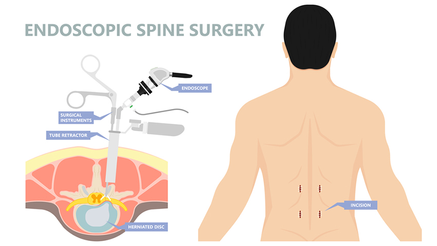 Endoscopic Spine Surgery in Hisar- Latest Technology at Orthomed Hospital