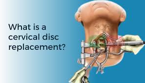 Cervical Disc Replacement in Hisar- Advanced Neck Surgery Options