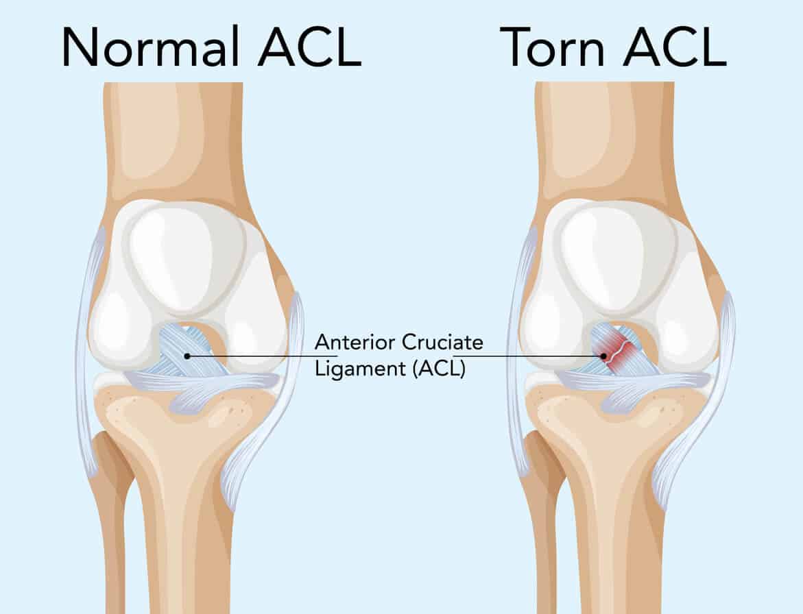 From ACL Tear to Full Recovery: A Complete Guide for Athletes