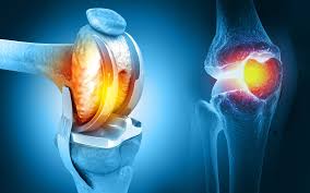 Joint Replacement Surgery: When Is It the Right Time?